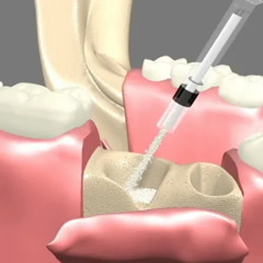 What to expect After Undergoing bone grafting  San Francisco