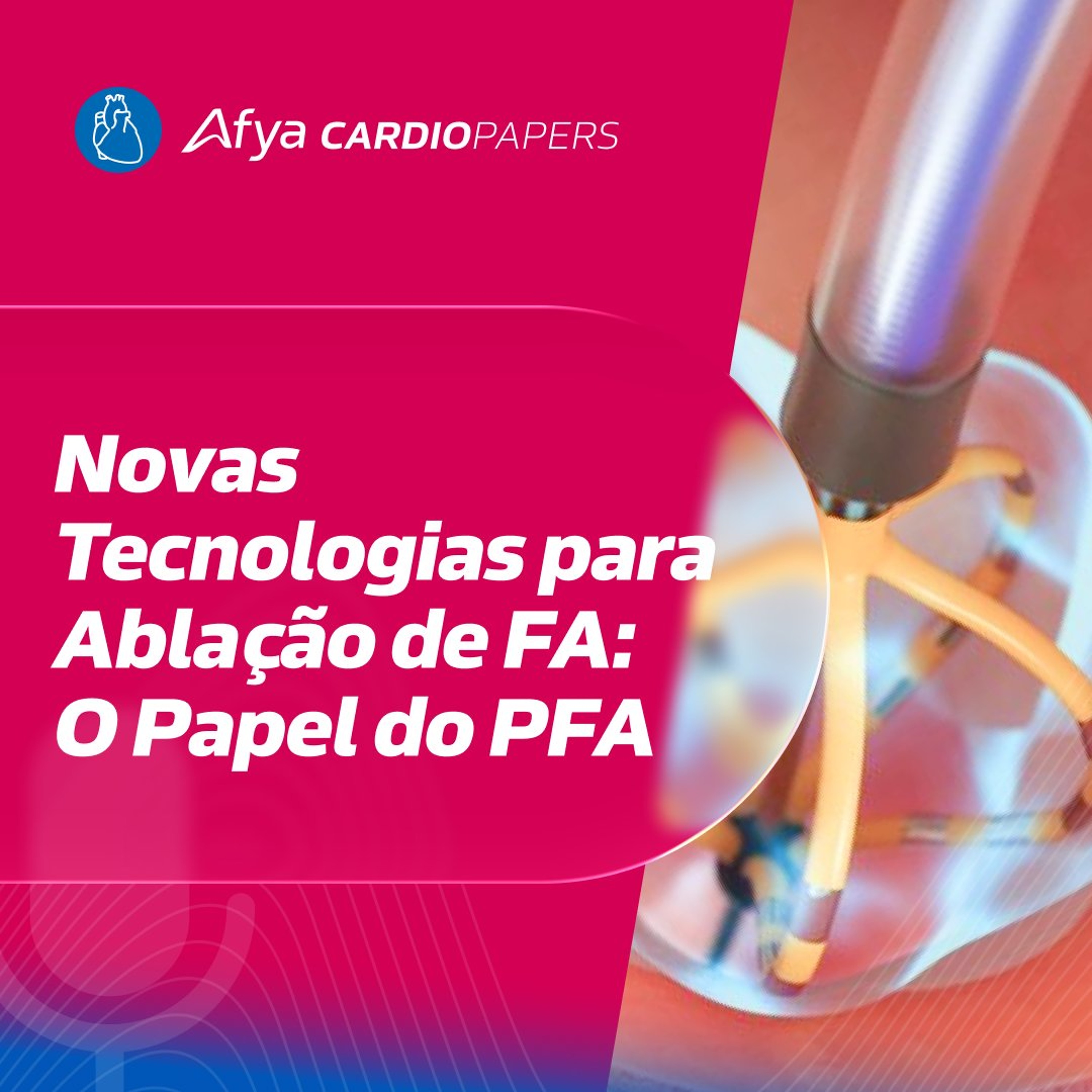 Novas Tecnologias para Ablação de FA: O Papel do PFA