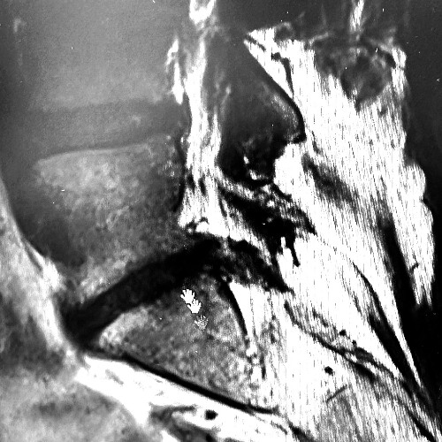 Herniated [FREE DOWNLOAD]