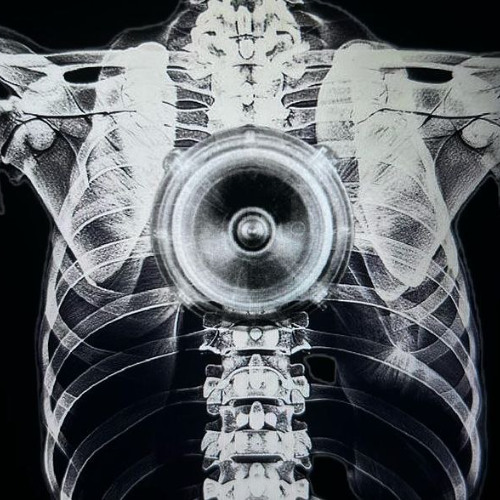 risklvp tumor #angelboys