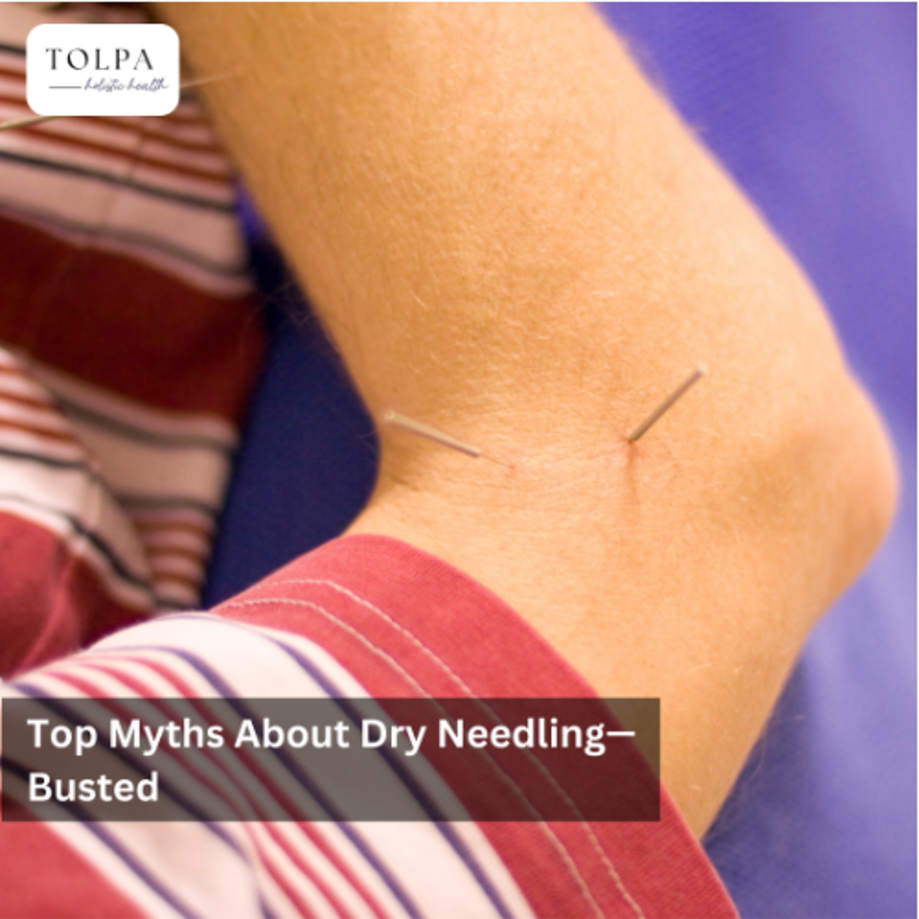 Top Myths About Dry Needling—Busted