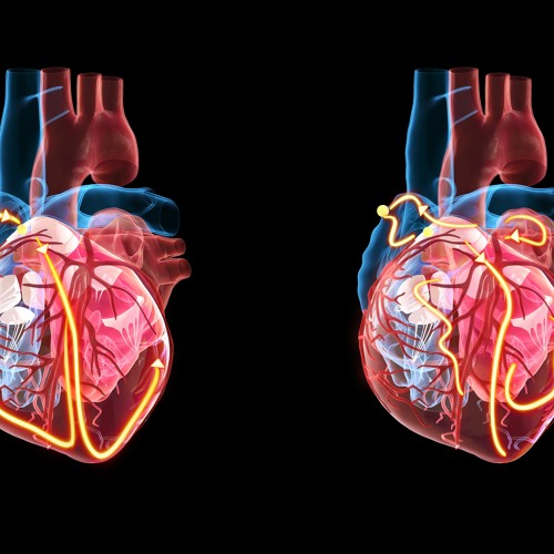 BLOG: Navigating the Frailty Factor in Atrial Fibrillation Management