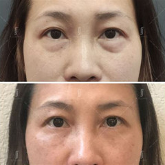 Best Eye Bag Laser Treatment Reviews