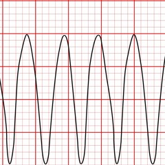 Ventricular Rhythms 2021