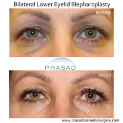 Best Under Eye Crease Treatment Reviews
