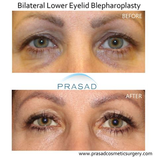 Best Under Eye Crease Treatment Reviews