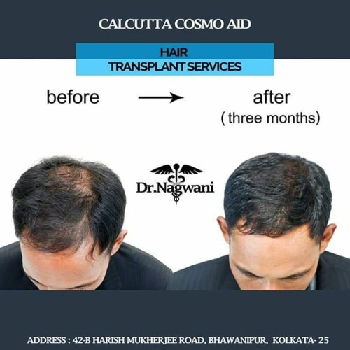 Stream Know About FUE Hair Transplant Method From The Best Surgeon In  Kolkata by Cosmo Aid | Listen online for free on SoundCloud
