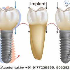 Visit Best Dental Implant Clinic in Faridabad to Get Quality Treatment