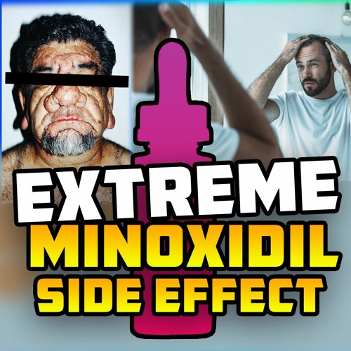 Stream episode MINOXIDIL SIDE EFFECTS THEY WON'T TELL YOU ABOUT –  PSEUDOACROMEGALY!? by More Plates More Dates podcast | Listen online for  free on SoundCloud
