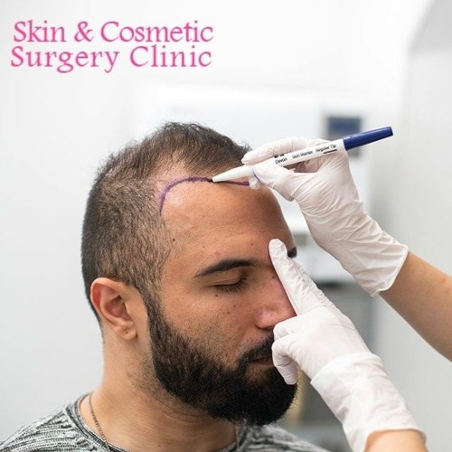 Stream Hair Transplant Mohali Combat Hair Loss With PRP by  Skin&CosmeticSurgery | Listen online for free on SoundCloud