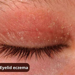Best Eczema Around Eyes Treatment Reviews