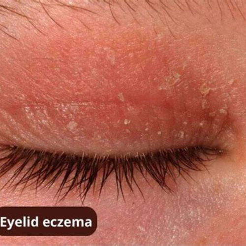 Best Eczema Around Eyes Treatment Reviews