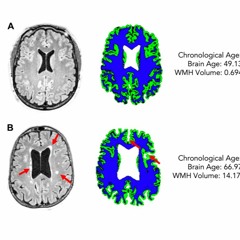 White Matter Hyperintensity Load Associated With Premature Brain Aging