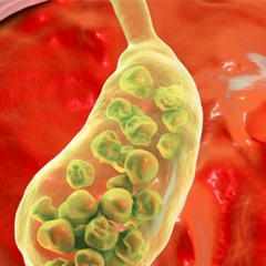 Gallstone Removal | Break and Expel Gallstones & Prevent Abdominal Pain