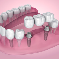 What’s the Difference Between Dental Implants and Dentures Find Out Which Is Right for You!