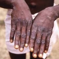 EP49[Swahili2] Oyé VS MonkeyPox Saison2 (2)