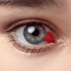 Best Treatment For Broken Blood Vessel In Eye Reviews