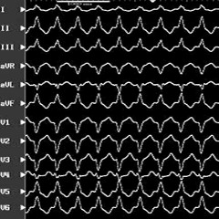 tachycardia as of 9/3/2025