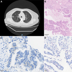 HER2-Mutated NSCLC in Brazil Shows Diverse Genetic Patterns and Treatment Gaps