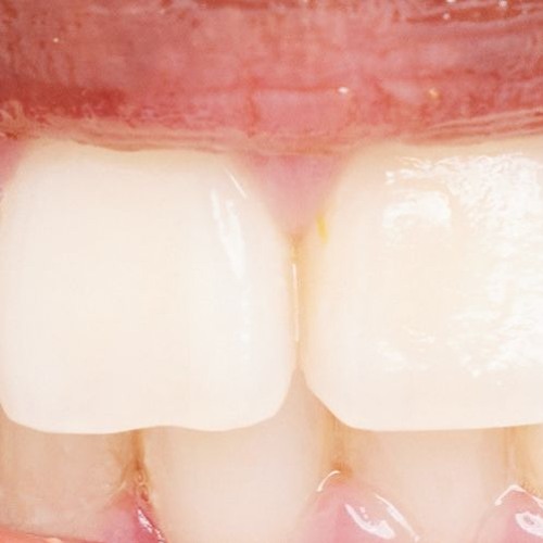 Pull out all your Teeth