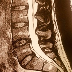 spinal pain