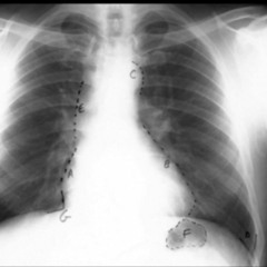 bubble screen be ready