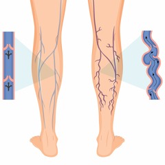 Beware of Vein Thrombosis! Visit a Vein Clinic for Timely Diagnosis and Treatment!