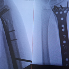 Distal Radius Fracture Trance Mix