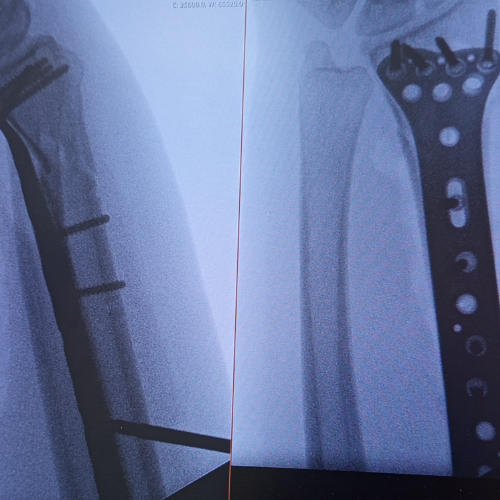 Distal Radius Fracture Trance Mix