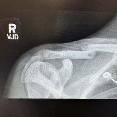 broken bones
