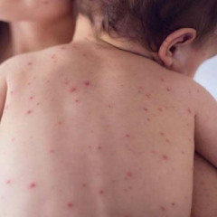 Lliana Fonseca-Alerta Nacional de Sarampión: Río Negro refuerza la prevención y vacunación