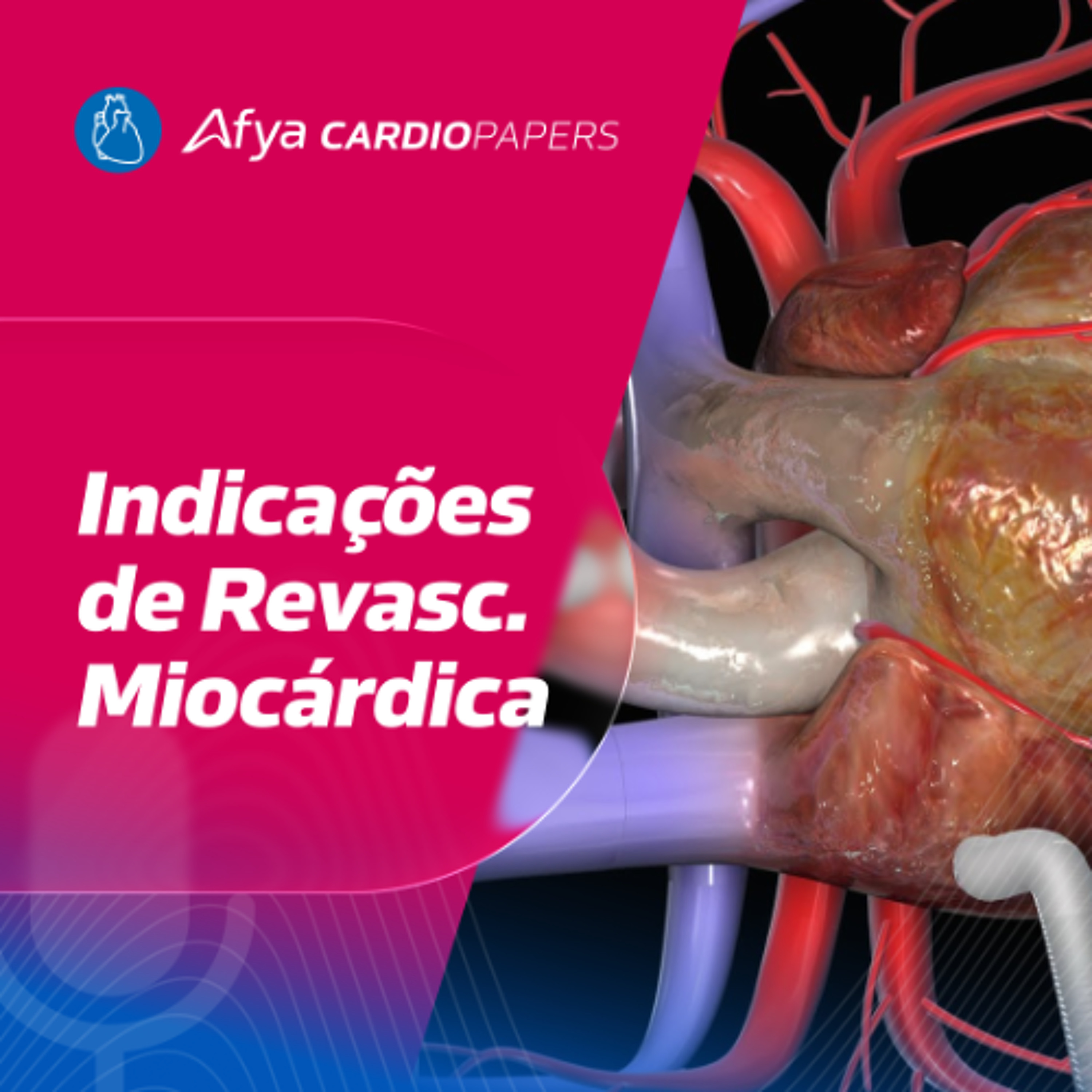 Quando indicar uma Revascularização Miocárdica?