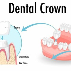 Caring for Your Dental Crowns and Bridges