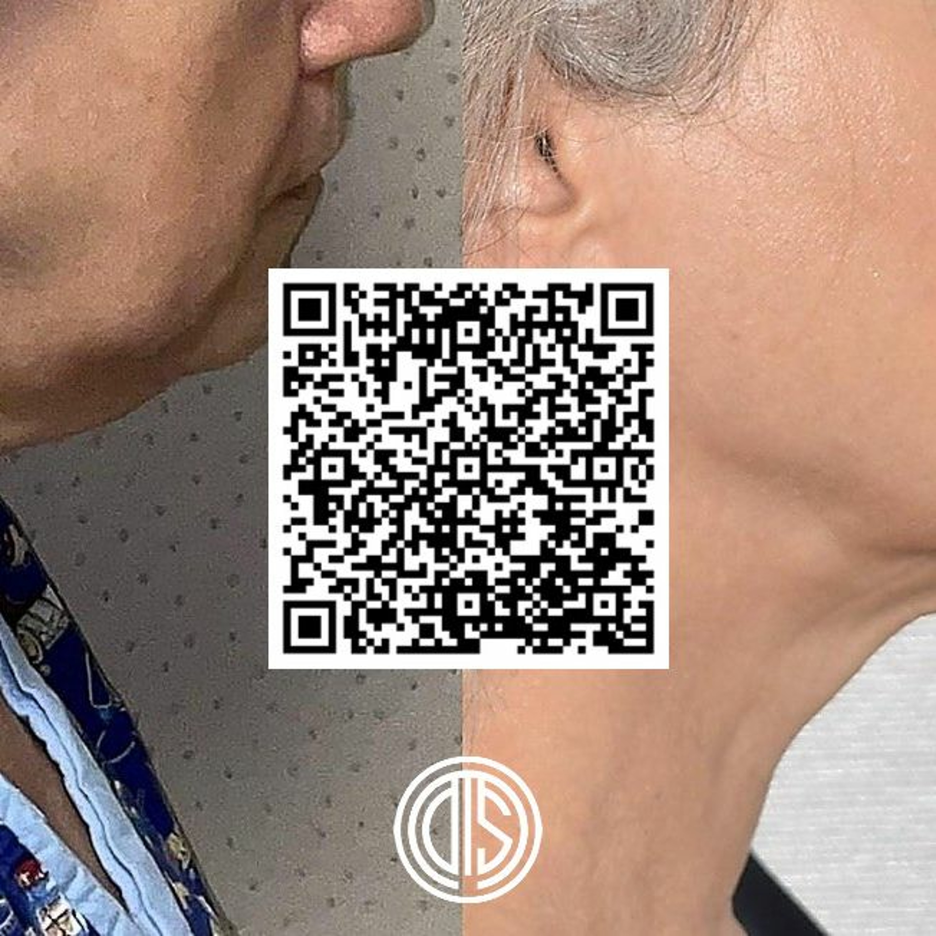 Darren Smith MD - Chin Liposuction Upper West Side Manhattan NY episode artwork