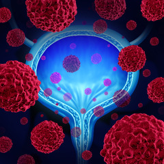 Exploring a Combined Approach: Radiation and Immunotherapy in Bladder Cancer