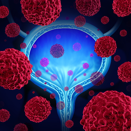 Exploring a Combined Approach: Radiation and Immunotherapy in Bladder Cancer