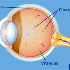 Best Is There Any Treatment For Eye Floaters Reviews
