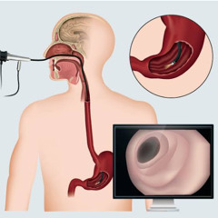 Endoscopia Gastrointestinal superior