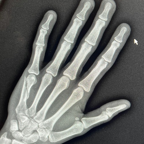 BROKEN BONES (Prod. buckx2)