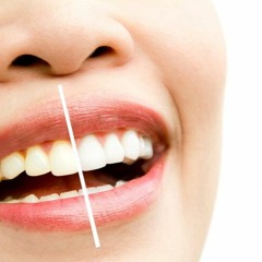 The Significance of Teeth Whitening