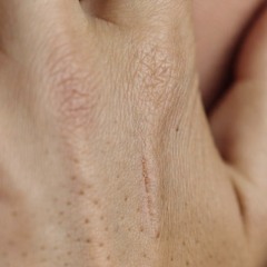 Scars