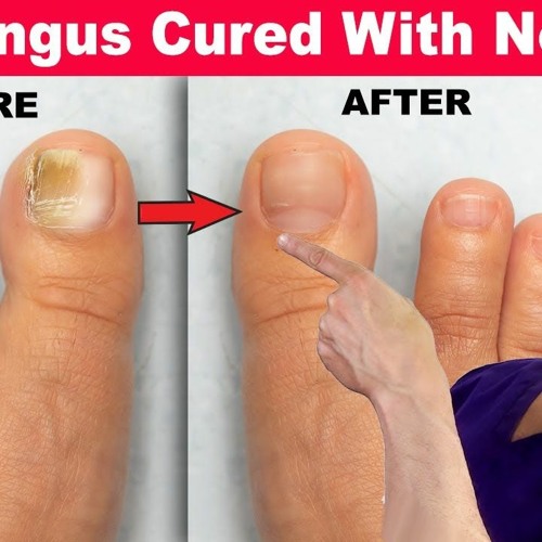 Stream episode Root causes of toenail fungus by science seeking truth