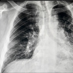 Black Lung: The Social Production of Disease