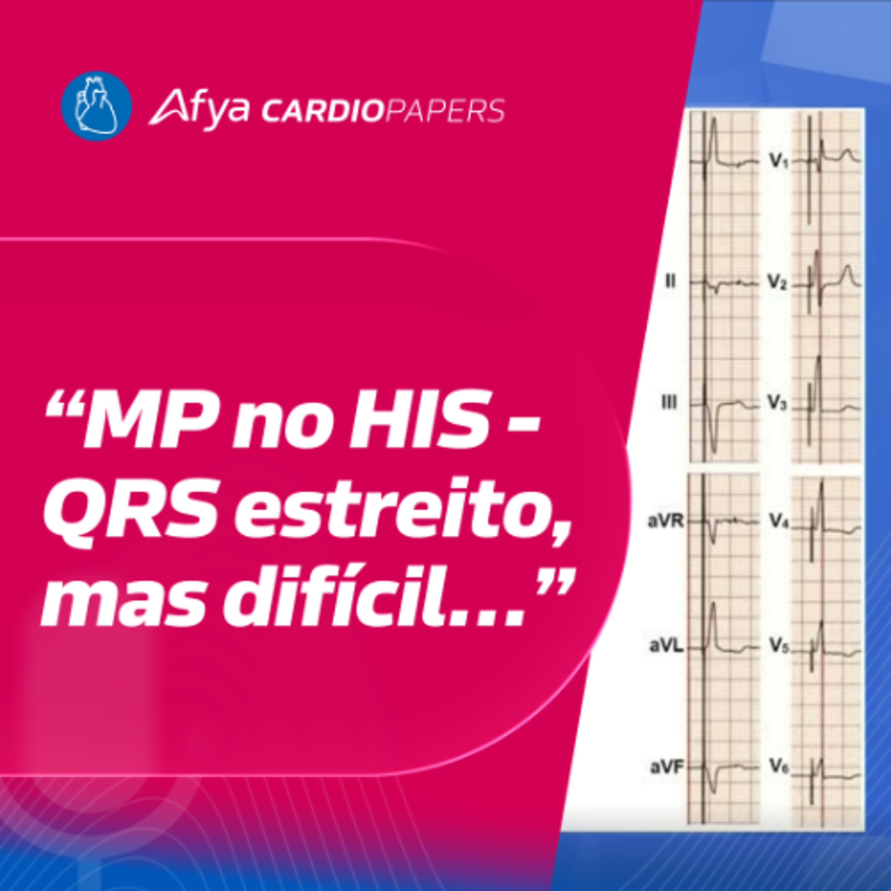 Marcapasso com estimulação do His: promessas e limitações