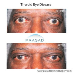 Best Graves Disease Eyes Treatment Reviews