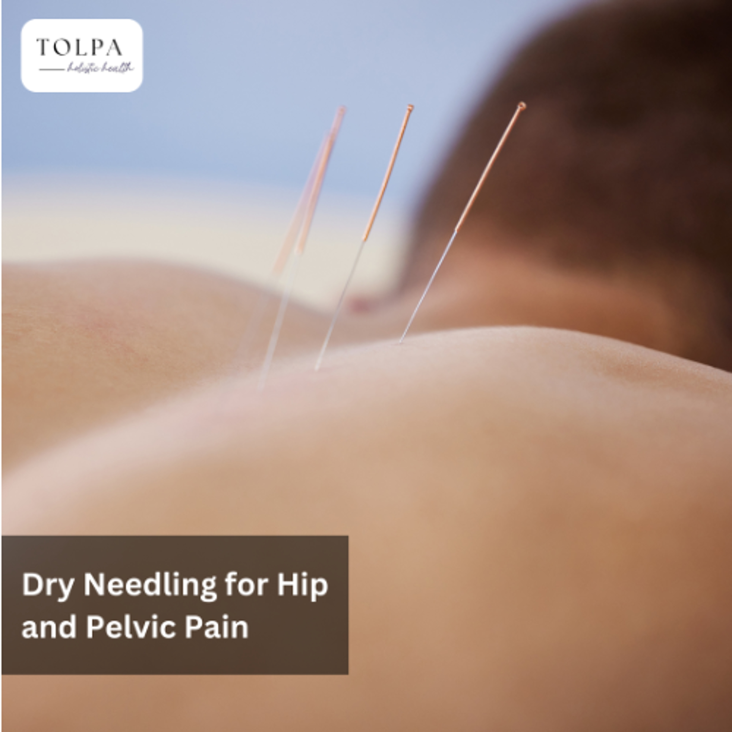 Dry Needling for Hip and Pelvic Pain