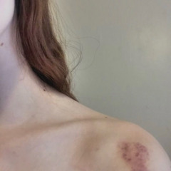 шрамы на теле