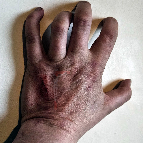 The Hurt