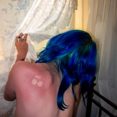 sunburn