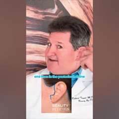 Will there be any scars after a face lift